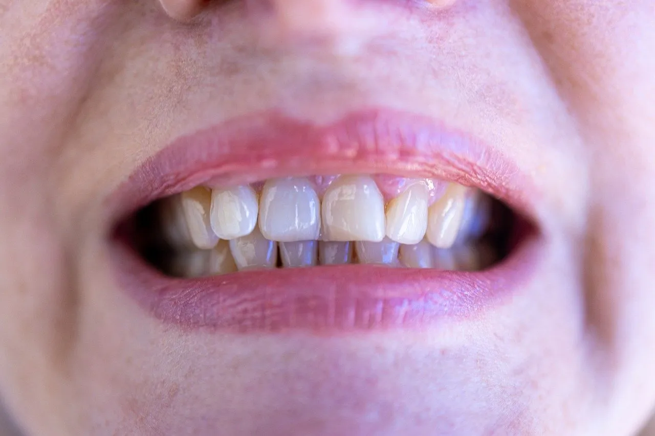 Comment se faire rembourser des soins dentaires ?