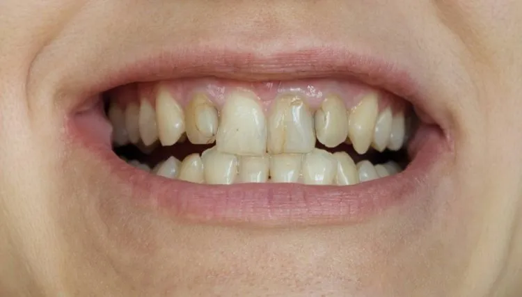 Dents abîmées : vous êtes mal dans votre peau ?