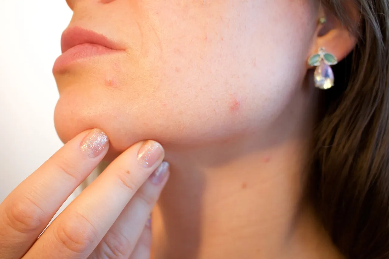 Personnalisation des soins pour la kératose séborrhéique